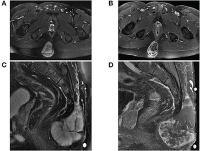 Recurrent Extradural Myxopapillary Ependymoma With Oligometastatic Spread